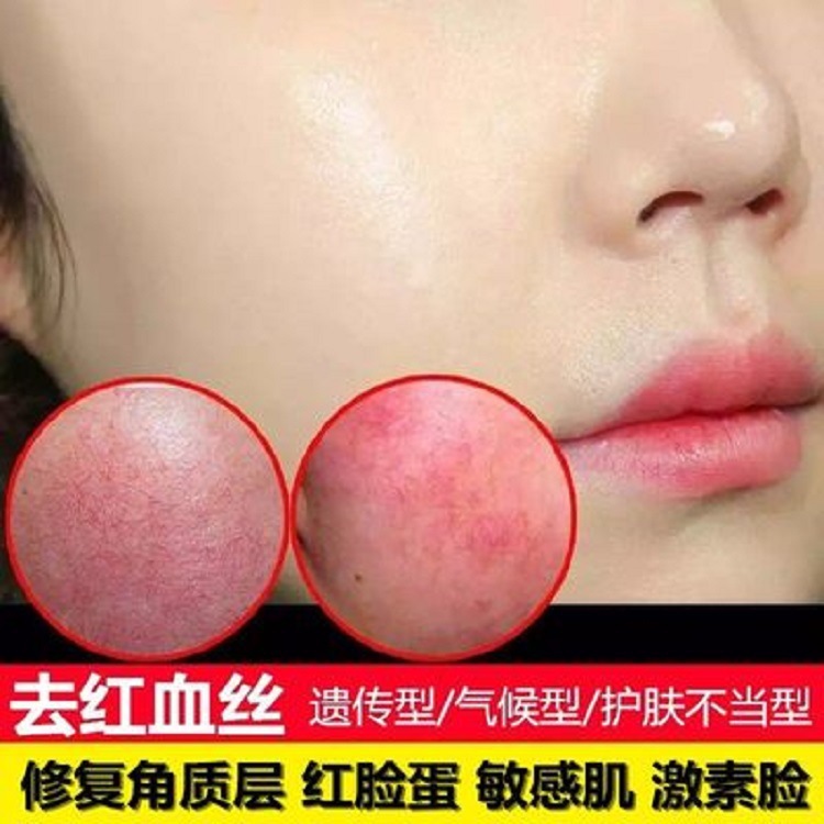Licorice repair solution red removing repair solution improving sensitive muscle hormone face repair red blood silk red removing repair solution