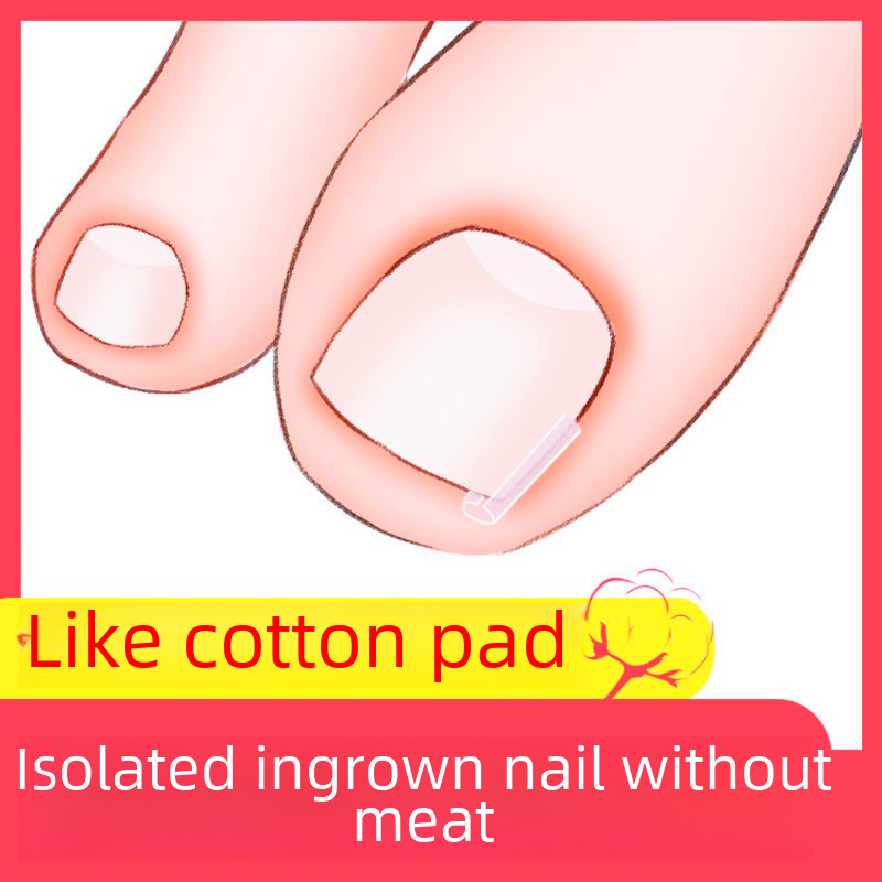 Nail Pad C- shaped Nail Pad Toenail Filling Pad Nail Groove Corrector Paste Nail Paste Nail Paste Toenail Long Meat