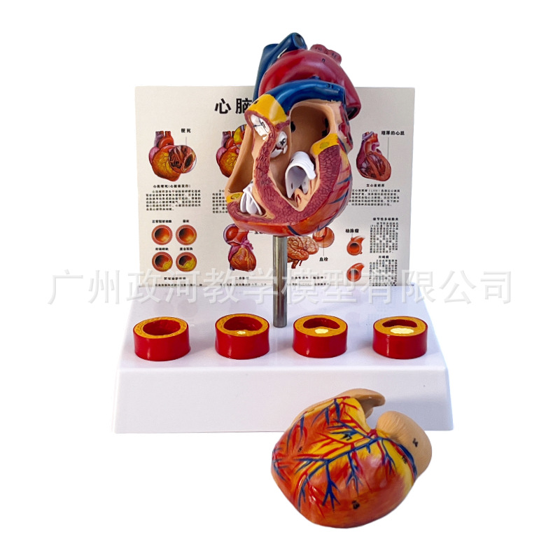 Standard Human Heart Model, Anatomical Detachable Teaching Artificial, Natural Large Heart with Blood Clot Blood Vessel Model