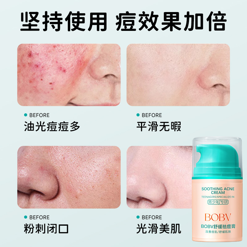 Bobv Soothing Herbal Acne Cream Fades Acne Marks, Removes Acne, Gently Controls Oil, and Is Specially Designed for Students to Treat Acne