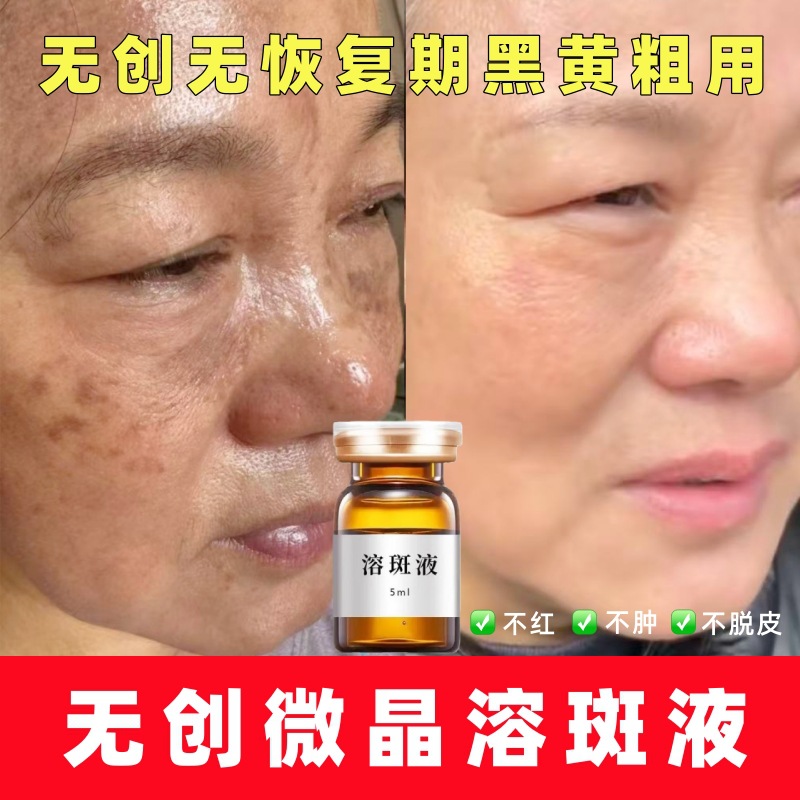 Косметический салон, неинвазивная жидкость для растворения пятен, разлагает меланин для удаления хлоазмы и веснушек без пилинга и неловкого периода, эссенция для удаления веснушек