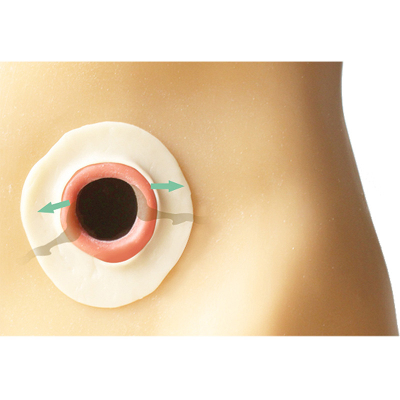 Cross-border Foreign Trade Leak-proof Ring Leak-proof Sticker Ring Stomostomy Plastic Sticker Ring Stomostomy Bag Ostomy Bag Care Supplies Leak-proof