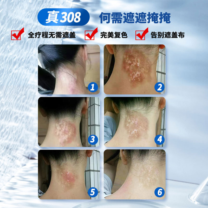 Vitiligo 308Nm Treatment Instrument Phototherapy Excimer Household Laser Ultraviolet Medical Physiotherapy Instrument Psoriasis 311