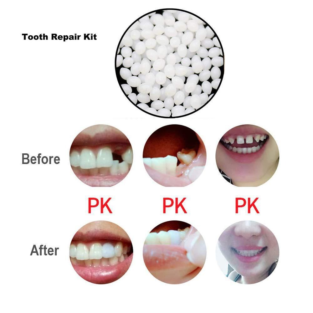 DIY Repair Gutta Perch Instant Smile Moldable Dental Glue for Tooth Filling