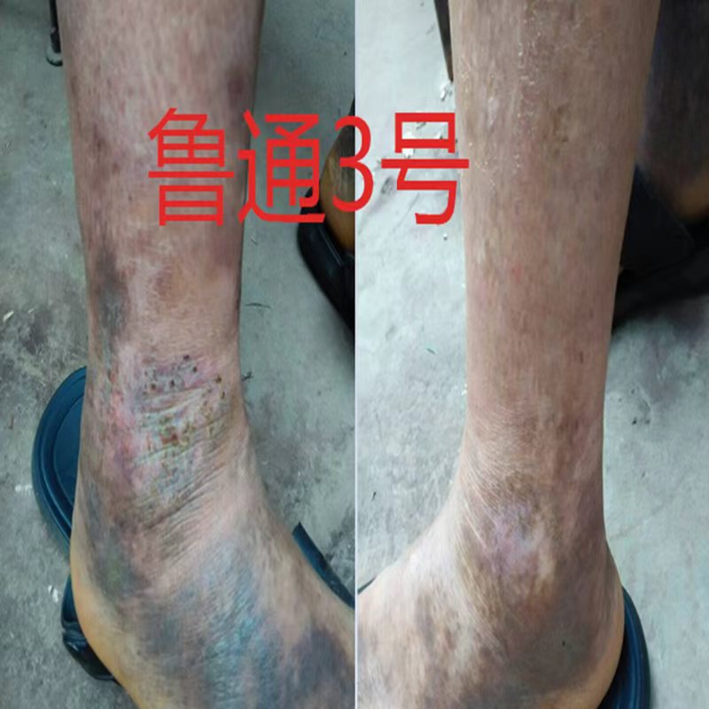 Lutong No. 3 Lower Limb Thrombosis