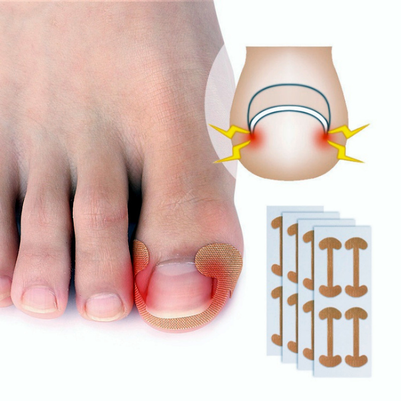 Cross-border Explosions Nail Repair Correction Lala Sticker Nail Correction Patch Nail Inlay Correction Patch Lala Sticker Free Paste Correction