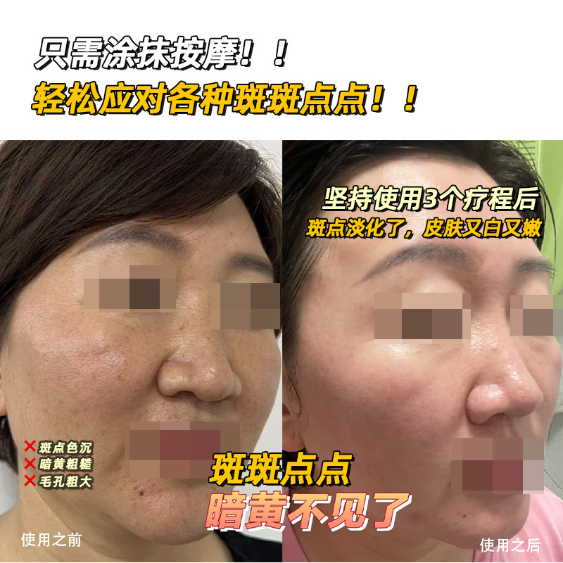 Five days bare-handed spot removal cream chloasma leather spot spot cream freckles whitening cream fried spot cream cosmetics