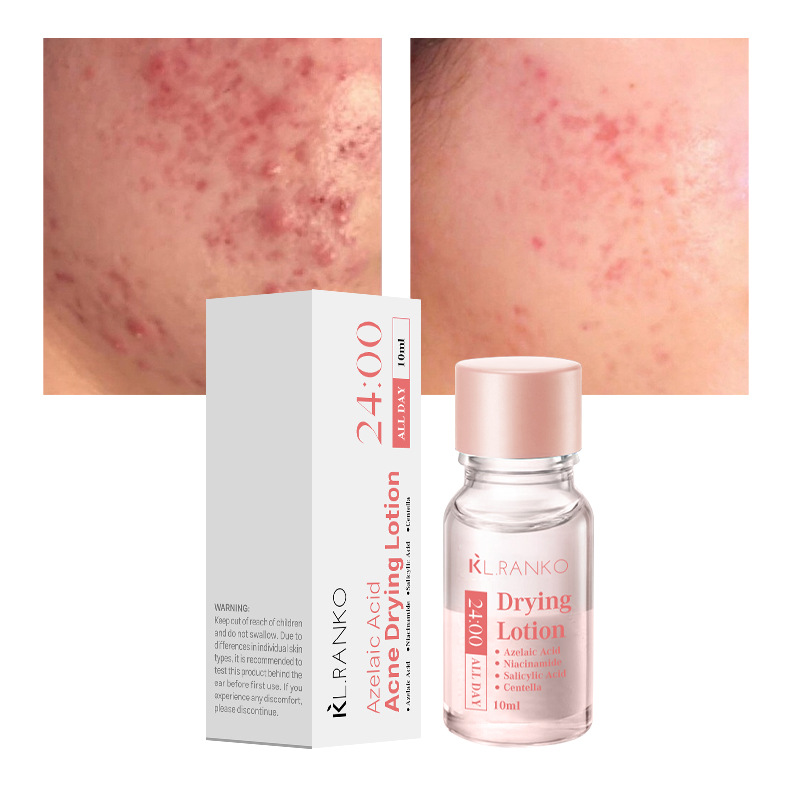 Cross-Border Best-Selling Salicylic Acid Anti-Acne Serum, Oil Control, Acne Clearing, Closed Comedones Care, Spot Application Anti-Acne Serum Water