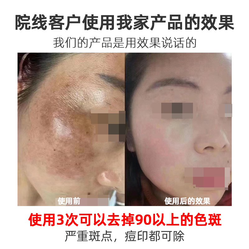 Five-Day Freehand Freckle Removal Cream Whitening Freckle Cream Chloasma Dermal Spot Freckle Cream Cosmetics Rejuvenation