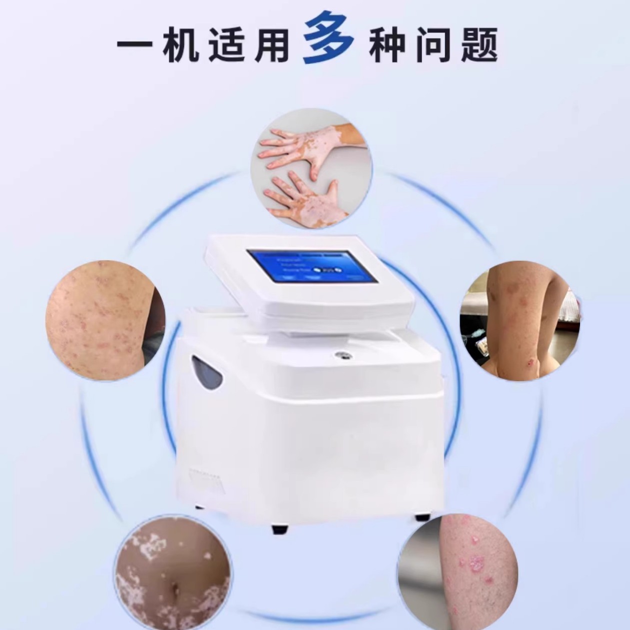 Vitiligo 308Nm Treatment Instrument Phototherapy Excimer Household Laser Ultraviolet Medical Physiotherapy Instrument Psoriasis
