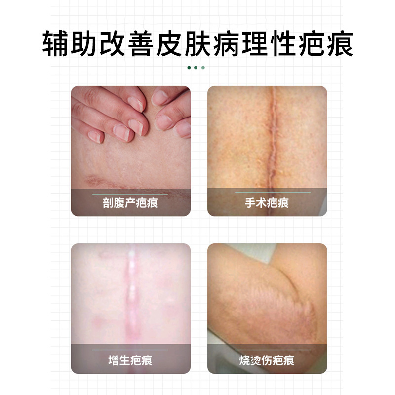 Beveya Scar Repair Patch Covering Patch Caesarean Section Scar Burn Scald Scar Repair