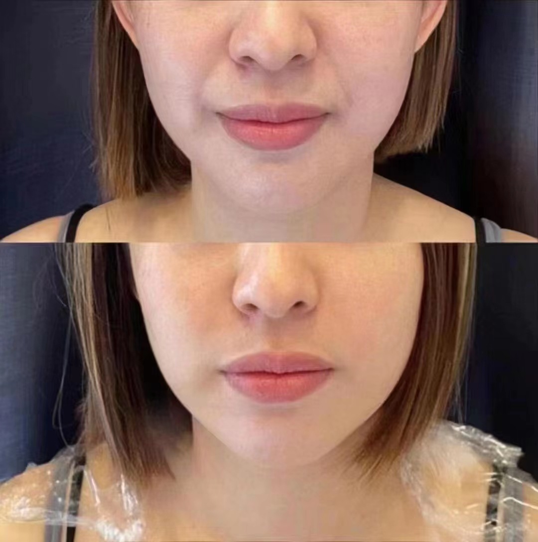 [High Concentration] Three-Line Lifting Firming Anti-Wrinkle Essence 9D Five-Line Fascia Lifting V Face Lifting Microneedle Introduction