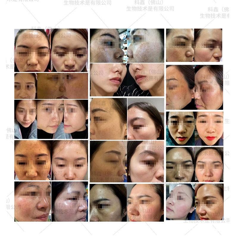 No embarrassment period to remove spots liquid color liquid desalination spots skin tone black thick yellow chloasma can wash face to do light bulb muscle