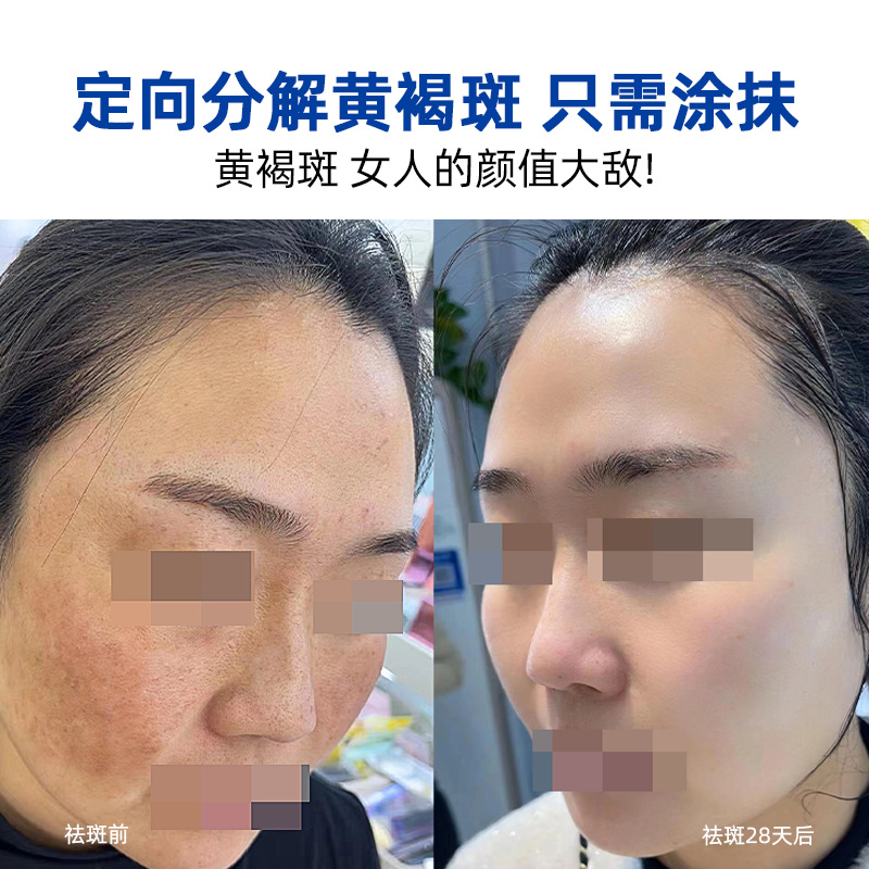 Non-Invasive Spot-Removing Liquid for Chloasma, Sun Spots, Dermal Spots, Freckles, Whitening Essence, Spot-Removing Water, Cosmetics