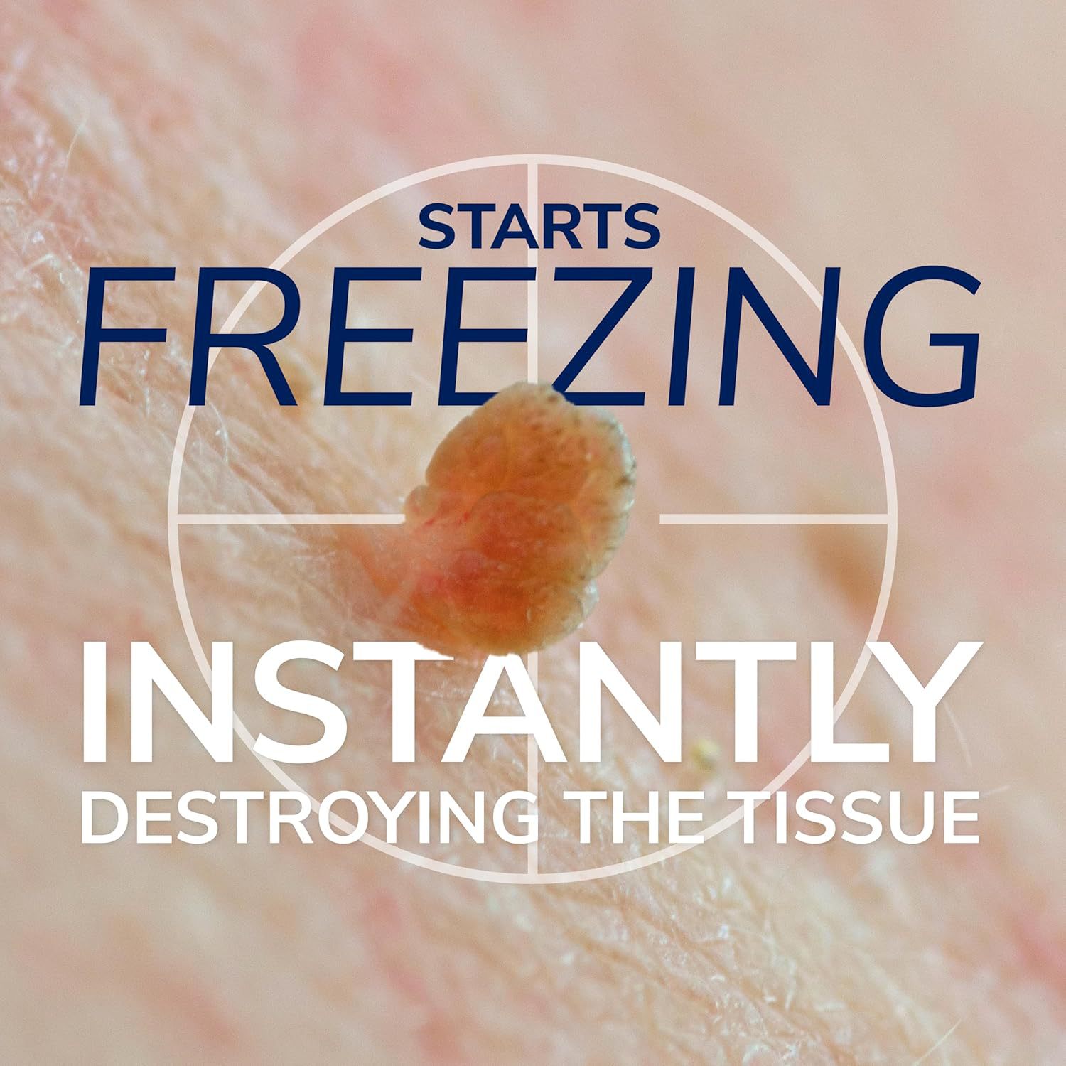 Cross-Border Skin Tag Remover for Home Use, Suitable for Removing Skin Tags and Moles for Women and Girls