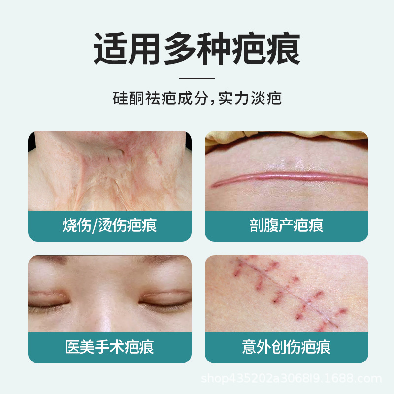 Wholesale Medical Scar Patches for Scar Removal, Cesarean Section Scar Hyperplasia, Surgical Scar Reduction, Scar Fading, and Postpartum Repair