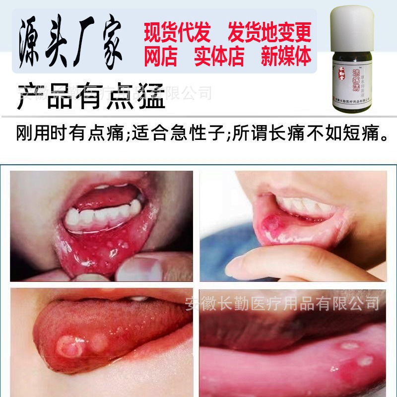 Changqin Brand Yidian Lingzheng Oral Gel for Mouth Sores, Zhengfeng Linjin Kuining Herbal Tea Shop, Sores Clearing and Repairing