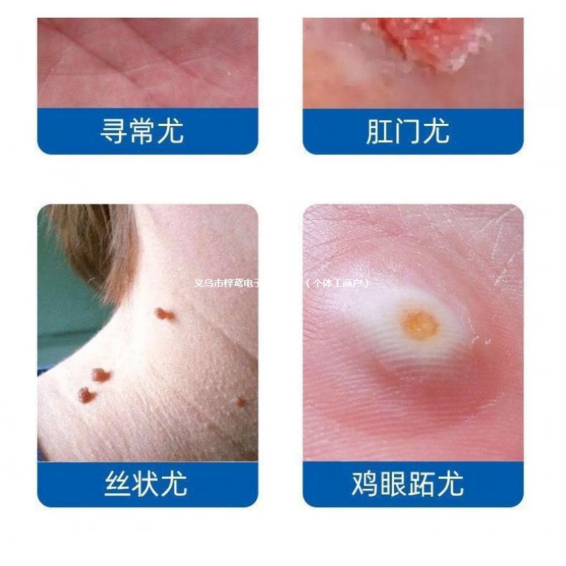 Pack a Bottle of Liquid Nitrogen for Freezing at Home for Personal Use! ! ! ! ! Free Shipping to Your Home