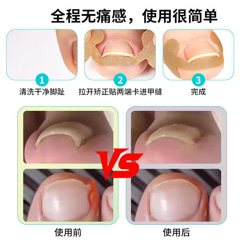 Toenail Correction Patch, Elastic Cloth Nail Groove Correction Patch, Disposable Nail Correction Patch, Nail Groove Correction Tool