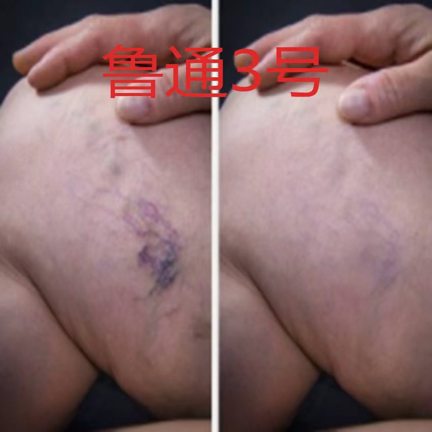 Lutong No. 3 Lower Limb Thrombosis