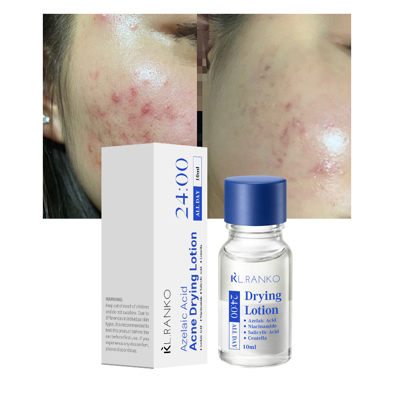 Cross-Border Best-Selling Salicylic Acid Anti-Acne Serum, Oil Control, Acne Clearing, Closed Comedones Care, Spot Application Anti-Acne Serum Water