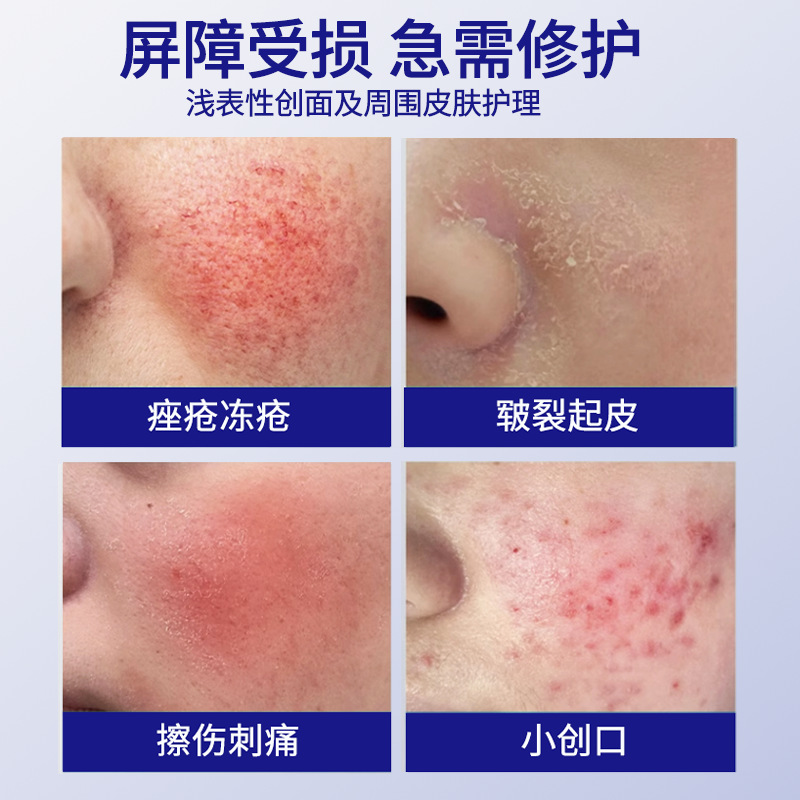 Cryotherapy Cream Skin Repair Moisturizing Scar Cream Medical Grade Skin Care Ointment Acne Cream Dropshipping Wholesale Centipede Protect