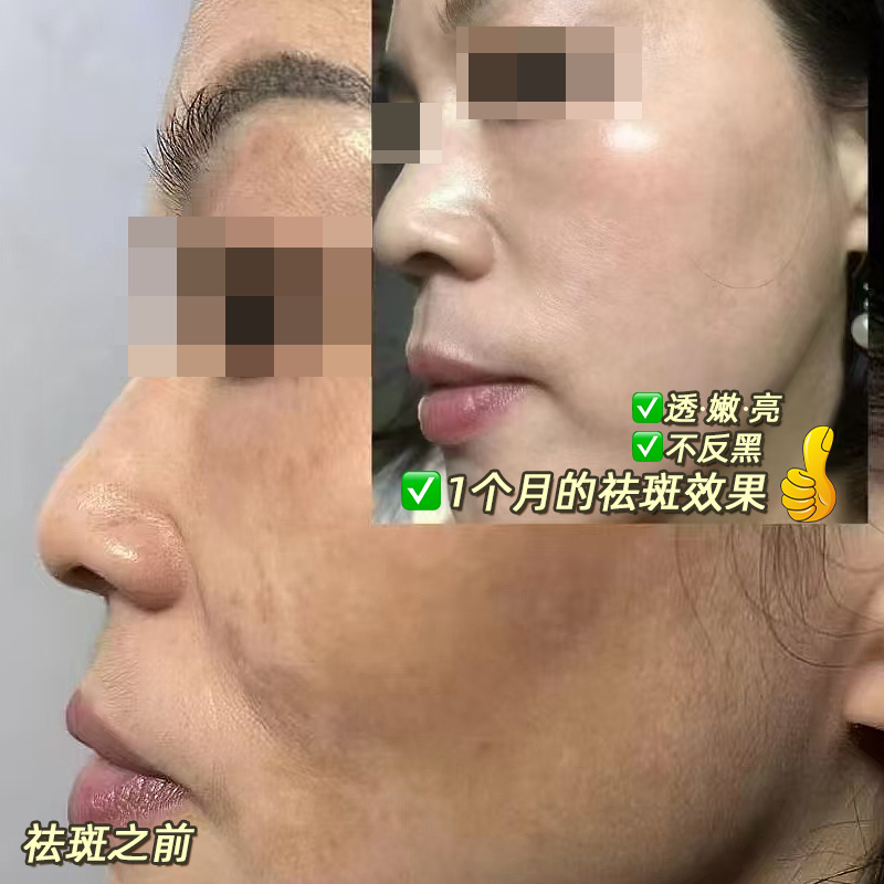 Special Essence for Genuine Leather Spots, Essence Oil for Age Spots and Chloasma, Anti-Darkening Maintenance Solution, Freckle Removal Essence