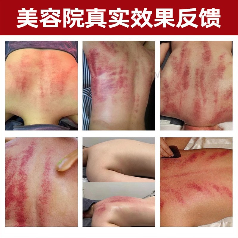 The Same Model of Royal Flora Non-Woven Mesh Health Body Kit Meridian Relief Massage Cream for Humpback by Master San Tong