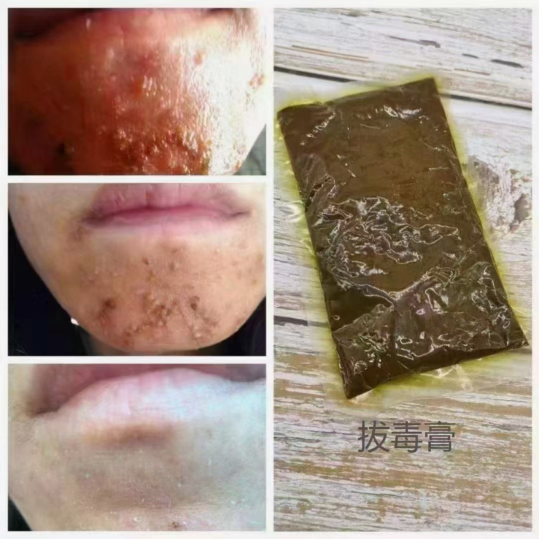 Herbal Beauty Cream Facial Skin Care Skin Repair Hormone Face Detoxification Lead and Mercury Beauty Salon Bulk Wholesale