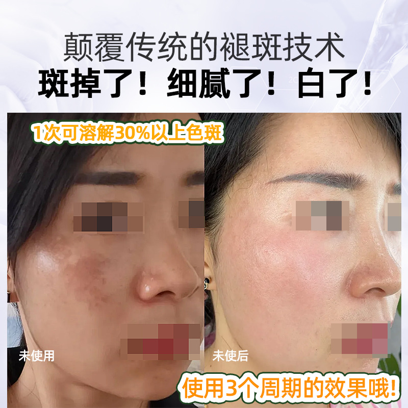 Freckle Removal Solution, Special Whitening and Freckle Removal Solution for Chloasma, Color Removal Solution, Black and Rough Yellow Essence, Brightening Essence Oil Cosmetics