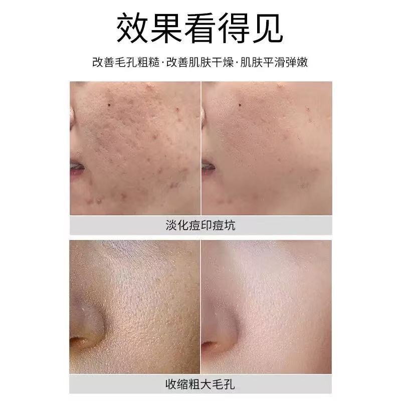 Small Green Film Sponge Microneedle Hospital Line Special Blackhead and Acne Mark Shrinking Pore Sponge Microcrystalline Powder 99% Needle Content