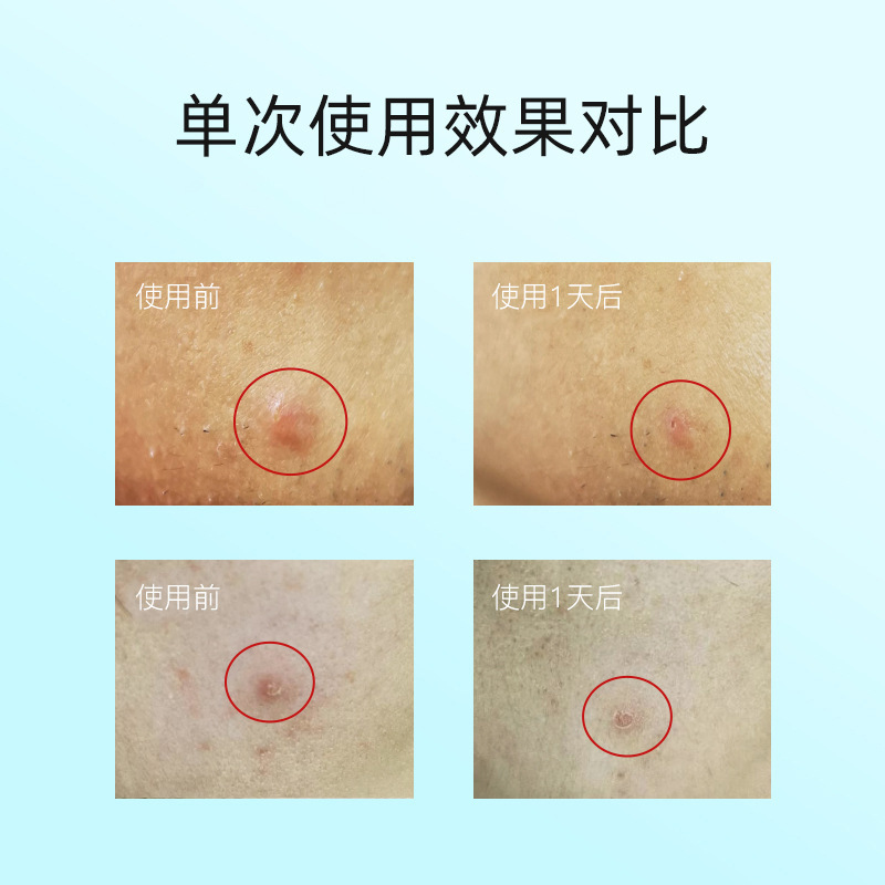 Cross-border hyaluronic acid microneedle acne patch invisible concealer soluble microcrystalline acne patch acne wholesale in stock