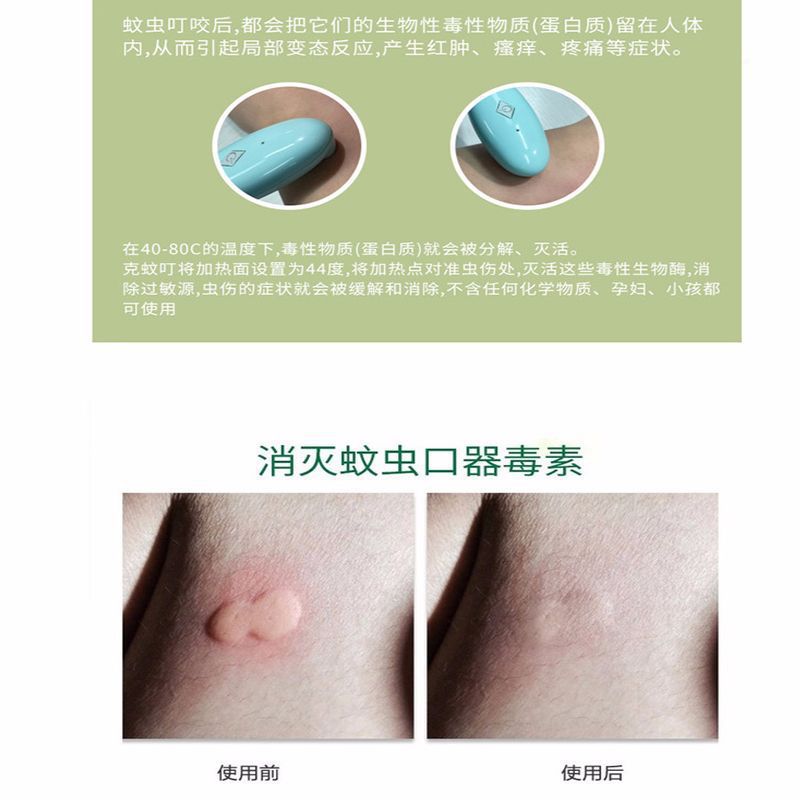 Amazon antipruritic instrument summer women baby mosquito bites fast antipruritic instrument children's anti-mosquito instrument physical antipruritic device