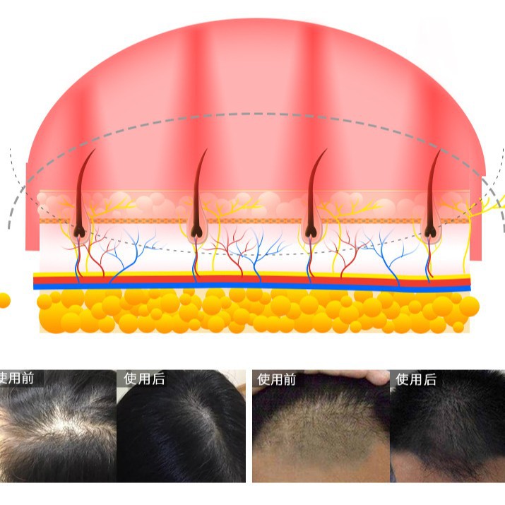Low Level Laser Therapy 650Nm Red Light Therapy Hair Growth Cap Laser Hair Growth Laser 118 Diode Infrared