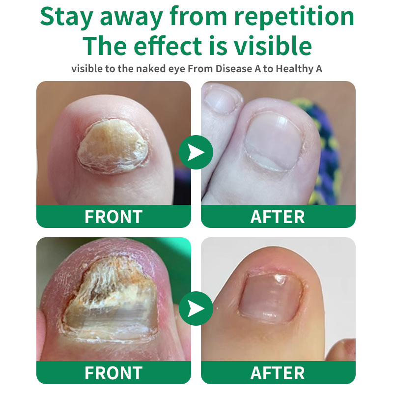 Cross-Border Akck Ginger Nail Care Solution Onychomycosis Repair Hand and Foot Nail Care Soft Nail Brightening Nail Moisturizing Solution