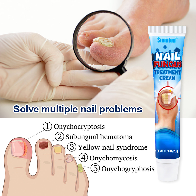 Lazada Aliexpress Sumifun Cross-Border 20g Nail Cream Onychomycosis Soft Nail Removal Ointment K10010