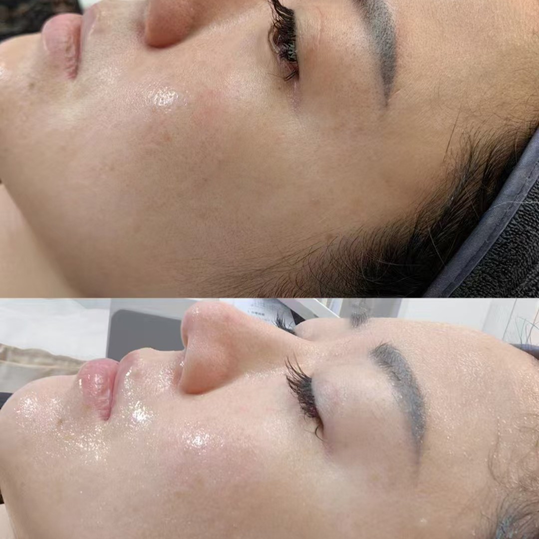 Skin Rejuvenation Cream with Micro-Needling, Sponge Micro-Crystal Cream for Youthful Skin, Bone Needle Manual Spot Removal Technique