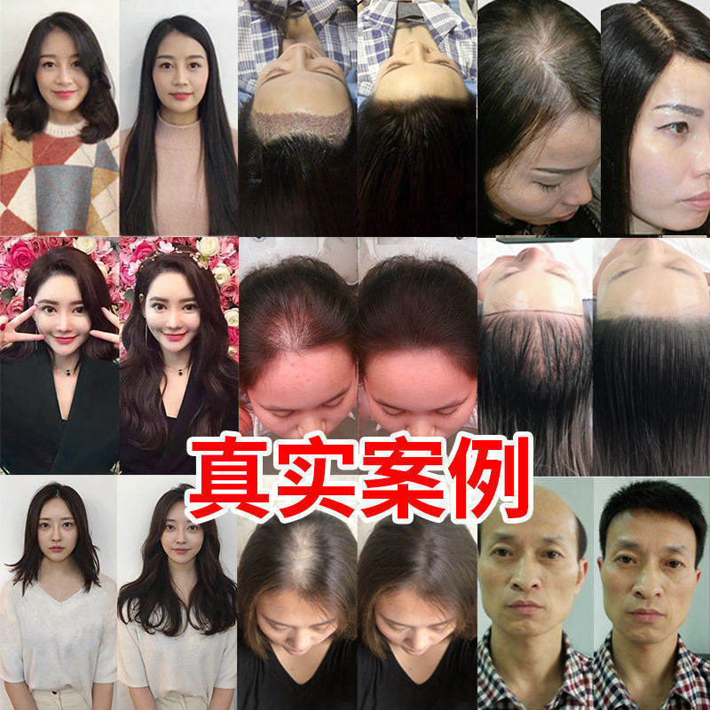 Herbal anti-hair loss hair growth liquid hair growth dense hair tough hair root hairline growth liquid hair growth liquid hair growth liquid