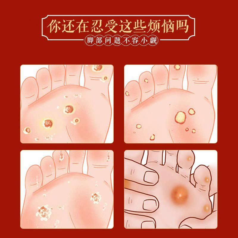 Pu Film Corn Patch, Corn Ointment, Callus Patch, Foot Callus Remover, Foot Care, Foot Relief, Jiyukang Patch, Corn Patch