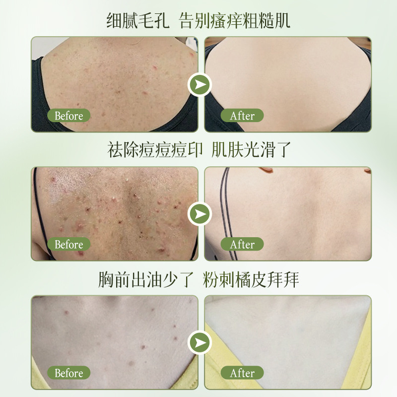 Bixutang Back Pox Clear Spray to Go Back Pox Refreshing Oil Control Brightening Skin Color Back Skin Care