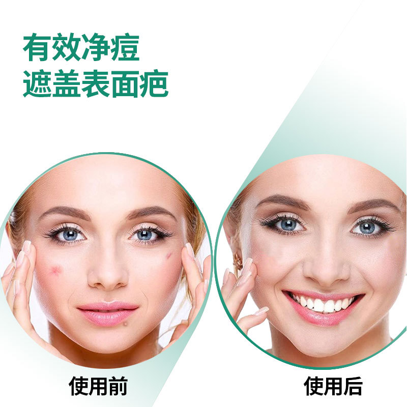 24 Capsules of Edge-Pressed Hydrocolloid Acne Patches, Round Moisturizing and Pus-Absorbing Acne Patches, 12 Capsules of Transparent Essential Oil Acne Patches, Invisible