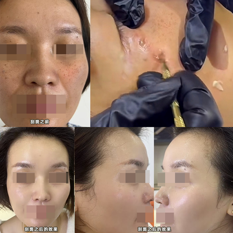 Spot Scraping Emulsion Spot Removing Essence Emulsion Plain Skin Bulb Skin Whitening Spot Removing Spot Revitalizing and Dissolving Spot No Embarrassment Non-anti-black Beauty Salon