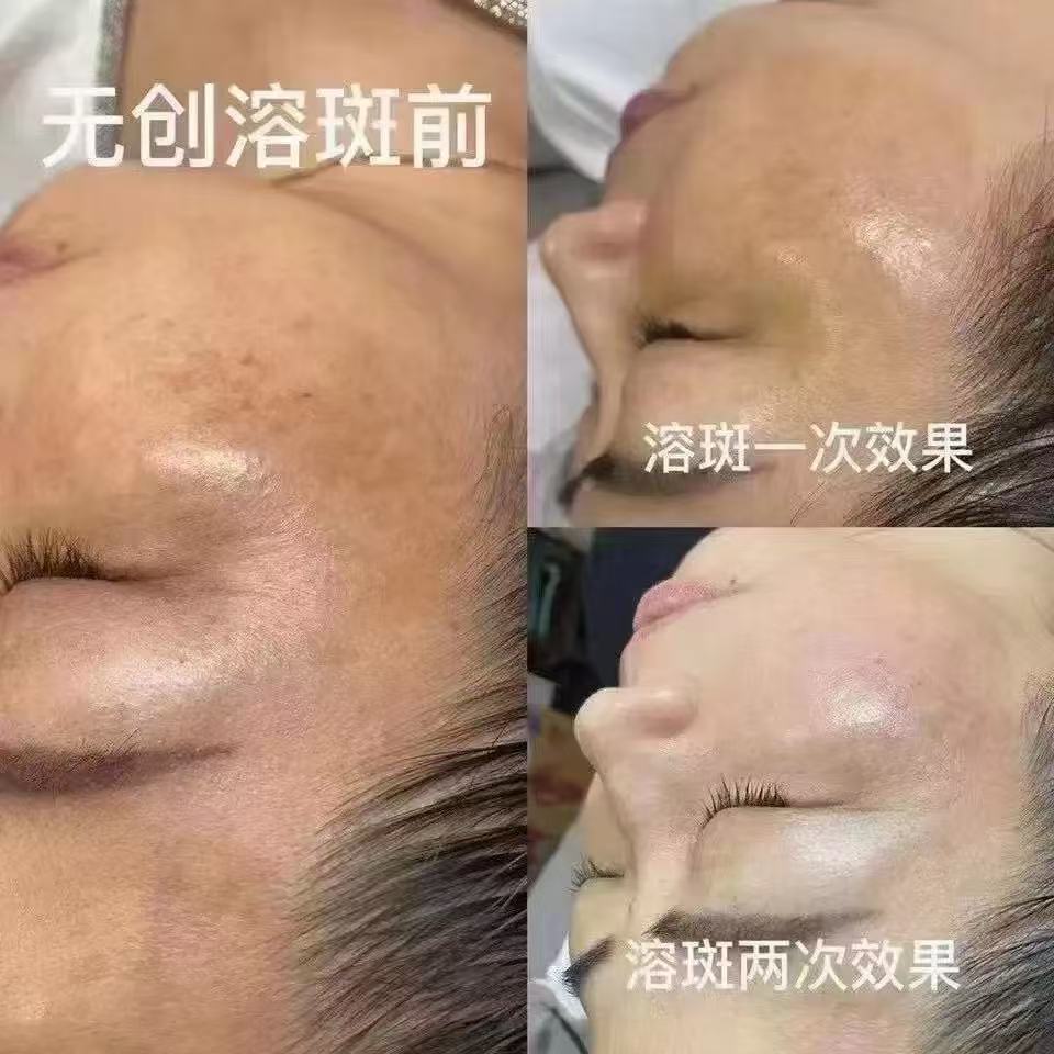 Beauty Salon Non-Invasive Spot Dissolving Liquid Decomposes Melanin to Remove Chloasma and Freckles Without Peeling and Without Embarrassing Period Freckle Removal Essence