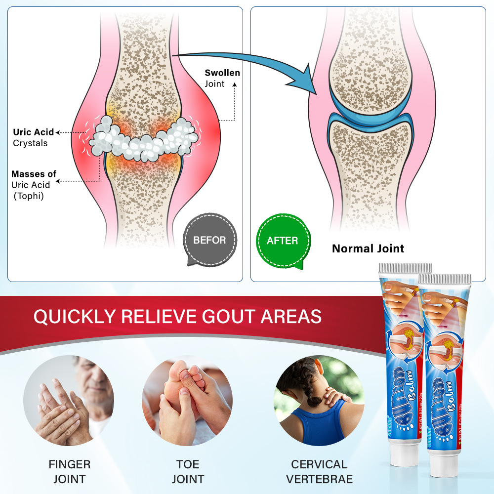 Sumifun Cross-Border Aliexpress Amazon Export Gout Cream Uric Acid High Bone Damage K10095