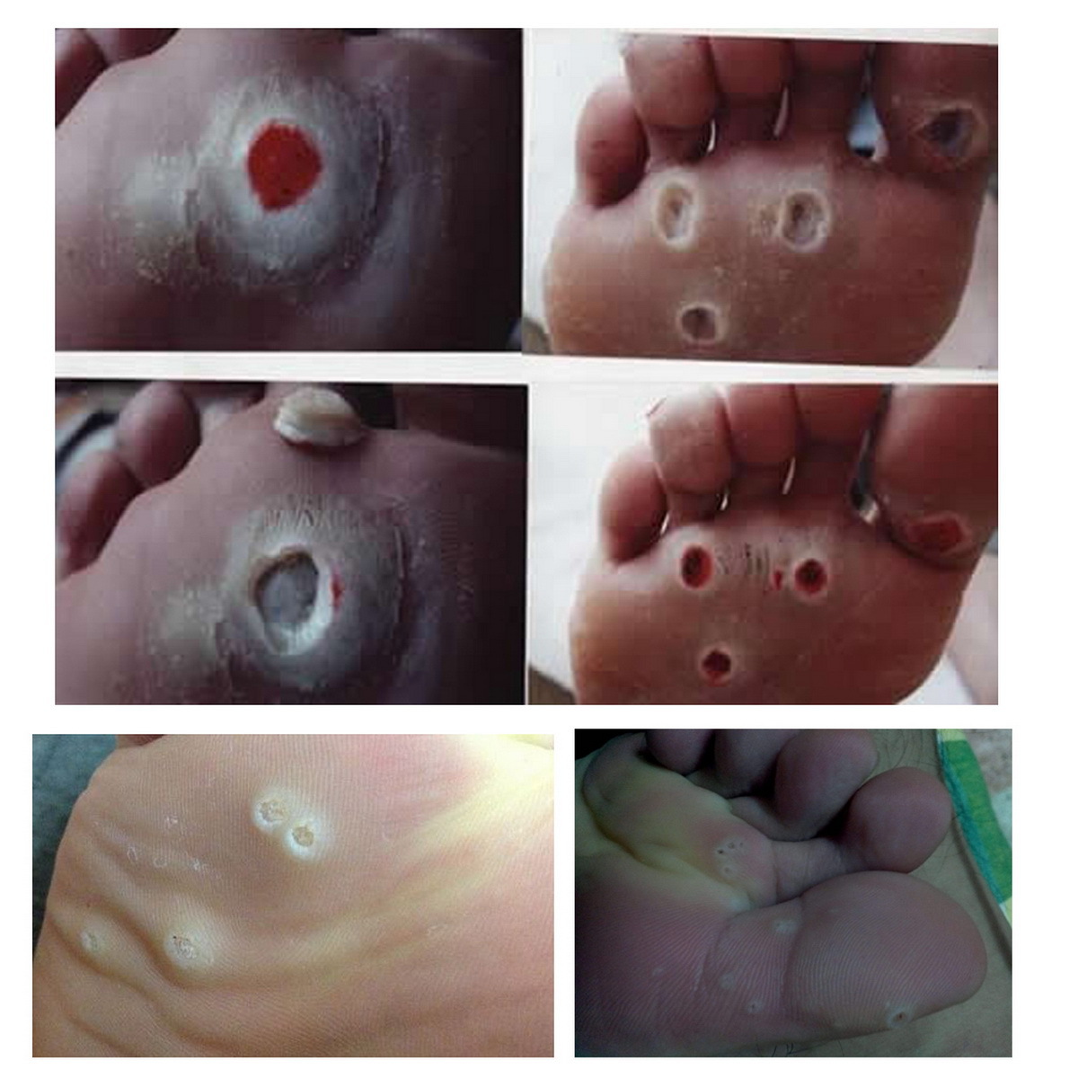 Chicken eye paste to remove callus Callus and callous callus wart wart wart wart wart wart cocoon foot pad