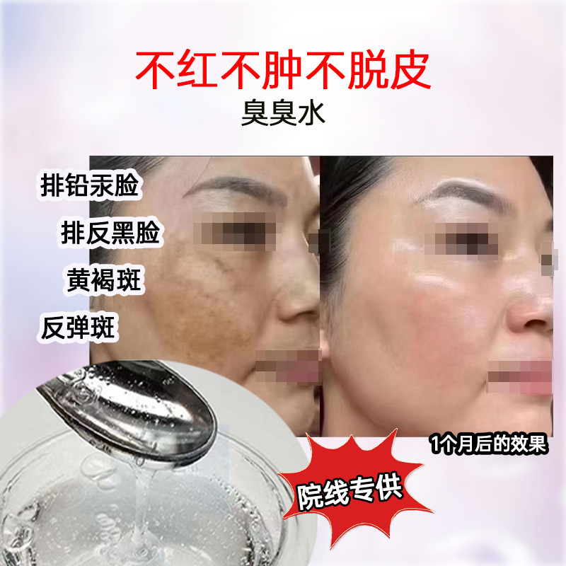 Smelly Water Removes Lead and Mercury Spots, Essence Whitens and Removes Spots, Brightens Original Solution, Chloasma Cosmetics, Lightens Spots and Brightens Skin