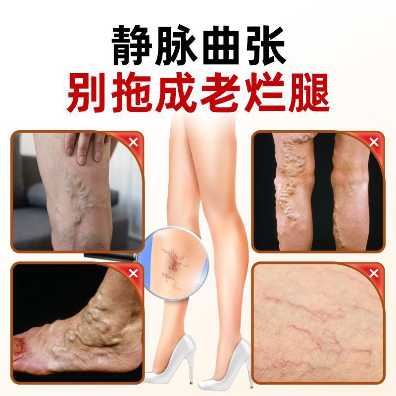 Медицинский жаропонижающий гель для варикозных вен Cross-Border индивидуальный заказ, универсальный венозный крем для всего тела, оптовая продажа с завода