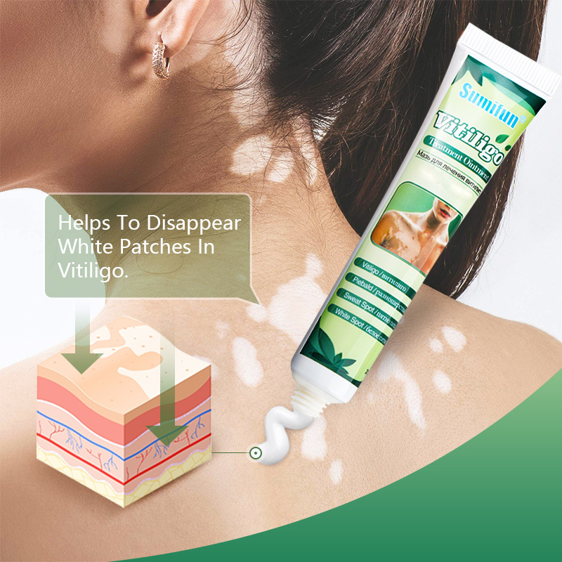 Aliexpress Sumifun White Spot Cream Sweat Spots Piebald Body Care Massage Cream Skin External Use K10020