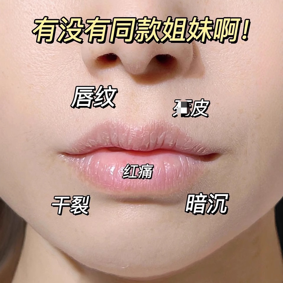 Lip Essence Oil B5 Lip Hydrating, Moisturizing, Diluting and Plumping Dry Skin, Lip Lines and Non-Greasy 5ml