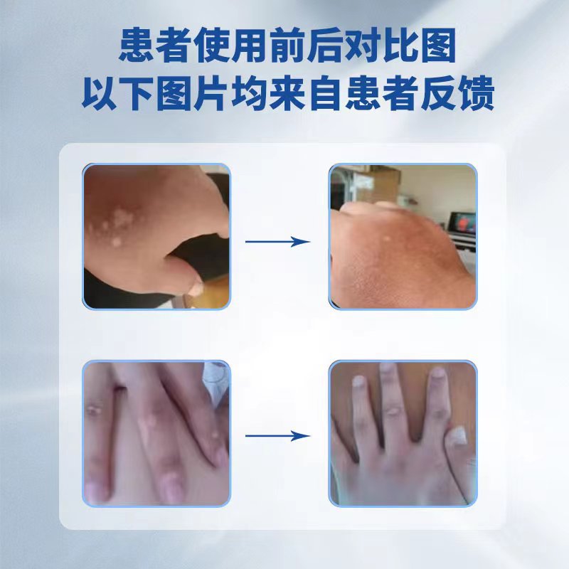 Vitiligo 308Nm Treatment Instrument Phototherapy Excimer Household Laser Ultraviolet Medical Physiotherapy Instrument Psoriasis 311